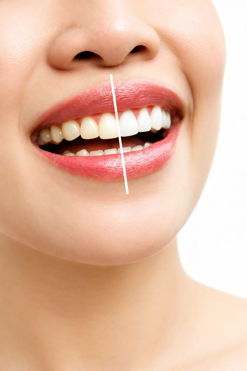 Before and After Smile Whitening